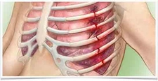 Kaburga Ağrısı Belirtileri ve Tedavisi