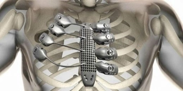 Kaburga Kemiği Aldırmak Riskleri ve Sonrası